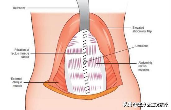腹部腹壁整形,腹壁整形恢复后腹部图片