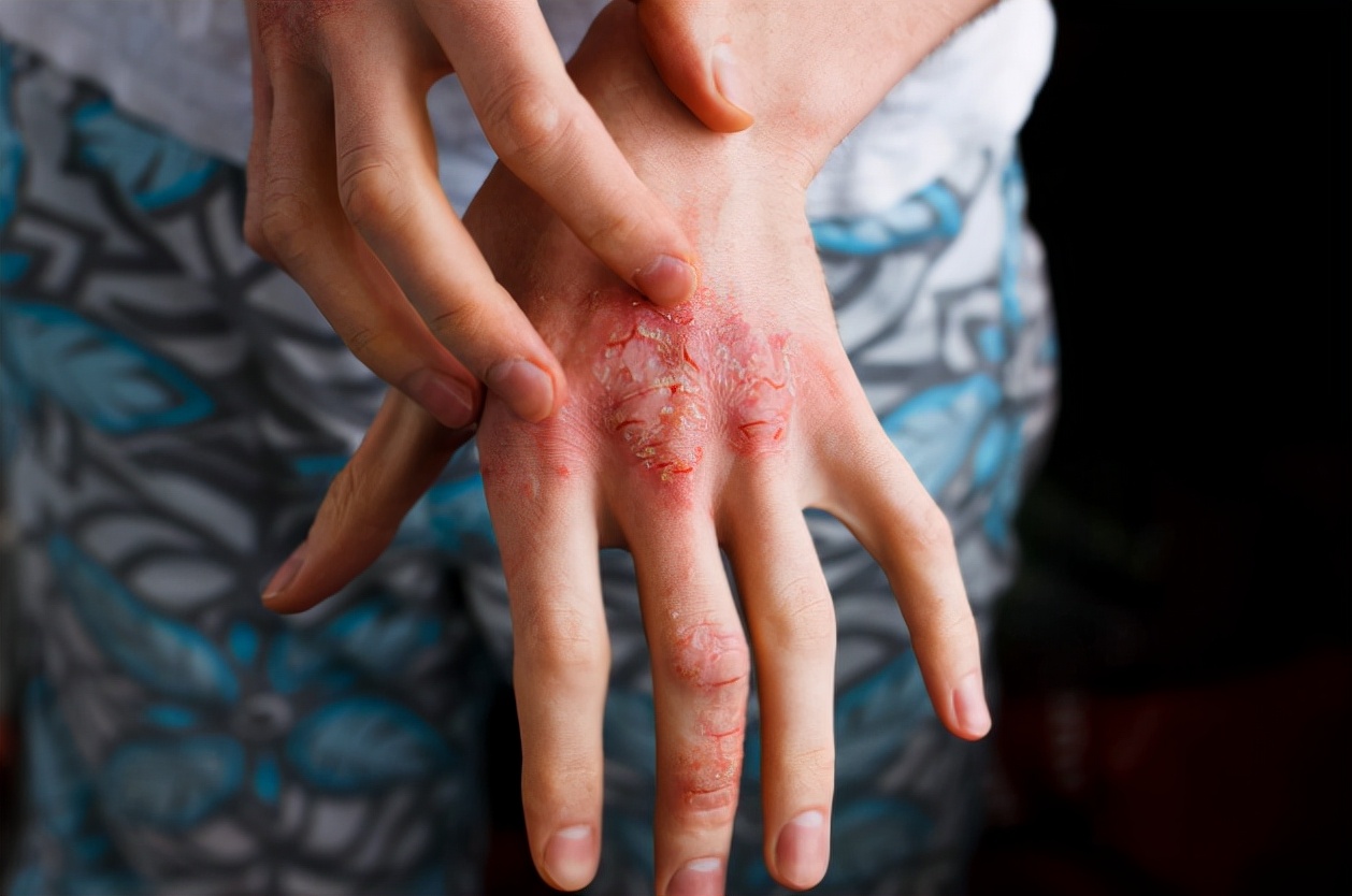 亲吻唾液过敏症状,亲吻皮肤后长水泡