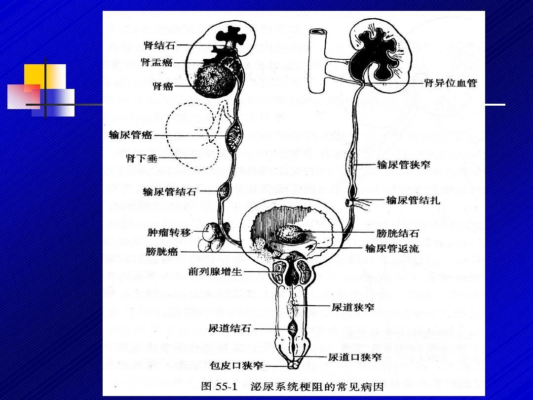 小便拉血是什么病的征兆,小便拉血