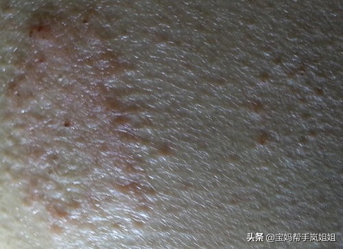 入秋宝宝皮肤突然干燥泛红有疙瘩,小孩手痒脱皮的原因和治疗方法