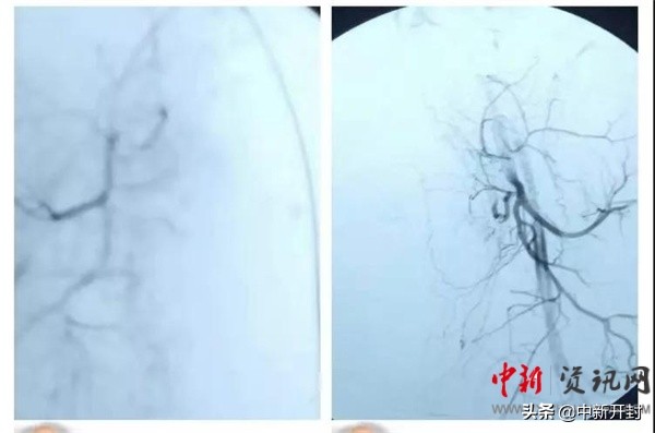 与死神搏斗之DIC，羊水栓塞