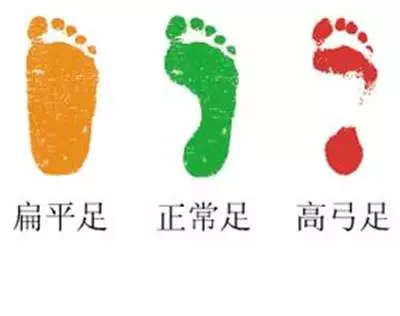 扁平足的危害一岁宝宝,现在的小孩好多的是扁平足
