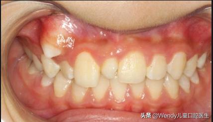 小孩乳牙掉了一直不长是什么原因,小孩乳牙掉了迟迟不出啥原因