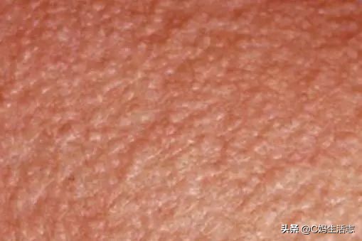 长痱子怎么办小妙招,夏天长痱子有什么食疗方法