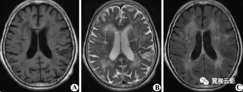 脑部脓肿怎么治疗,多发性脑脓肿能自愈吗
