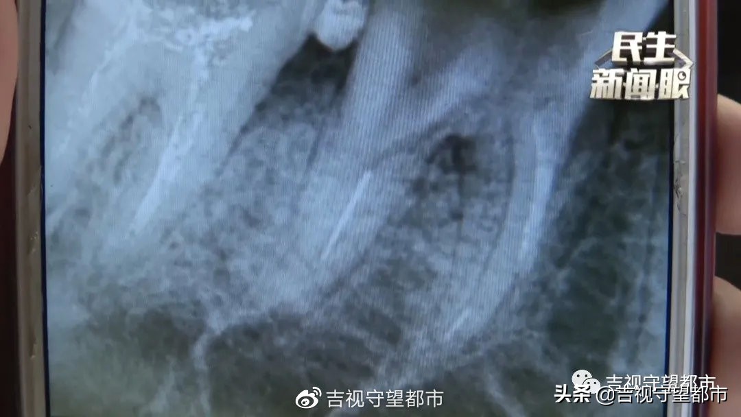 针管治疗中牙一直疼,牙里藏一根针可以治好吗