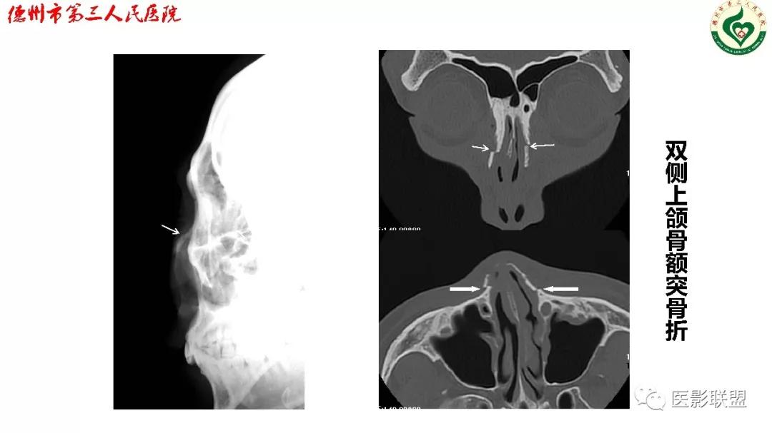 鼻骨骨折dr影像表现,鼻骨骨折影像学诊断