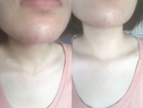 超好用的祛痘膏便宜,有没有好用的祛痘膏推荐女孩子