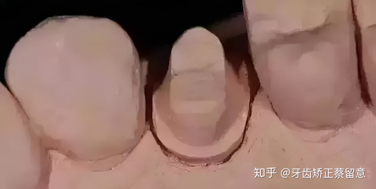 全瓷牙冠戴好了感觉咬合高了,戴了牙冠感觉大牙咬合不住