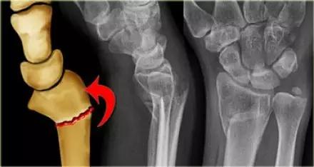 所有骨折都叫什么名字,骨折的名称有哪些