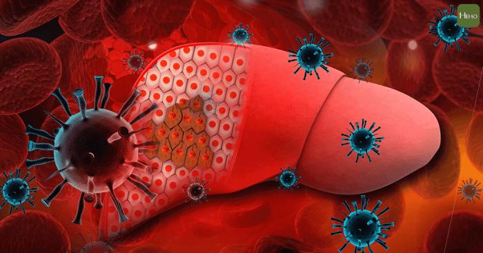 肝癌早期发现早期治疗很重要,制服癌