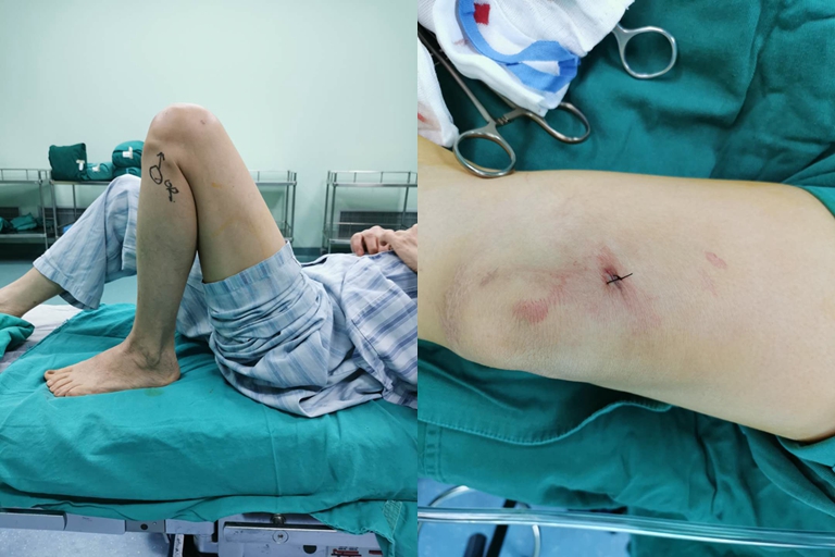 阿婆路边摔伤,阿婆骨折手术