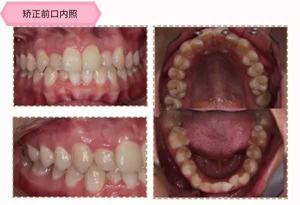 有兔牙如何改善,兔牙怎么矫正