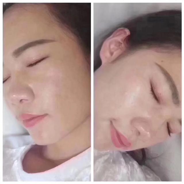 七老真的能修复激素脸吗,七老真的能修复好激素脸吗