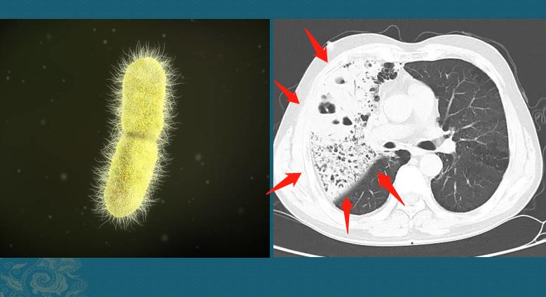 糖尿病肺炎克雷伯用什么抗生素,糖尿病足合并肺炎克雷伯菌感染