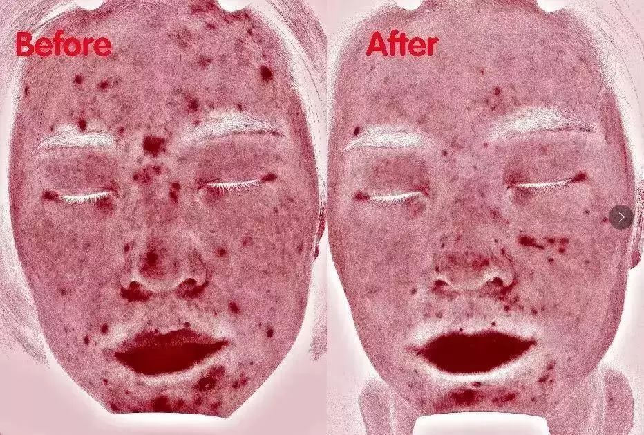 为啥不能挤痘,为什么不能挤嘴上的痘痘