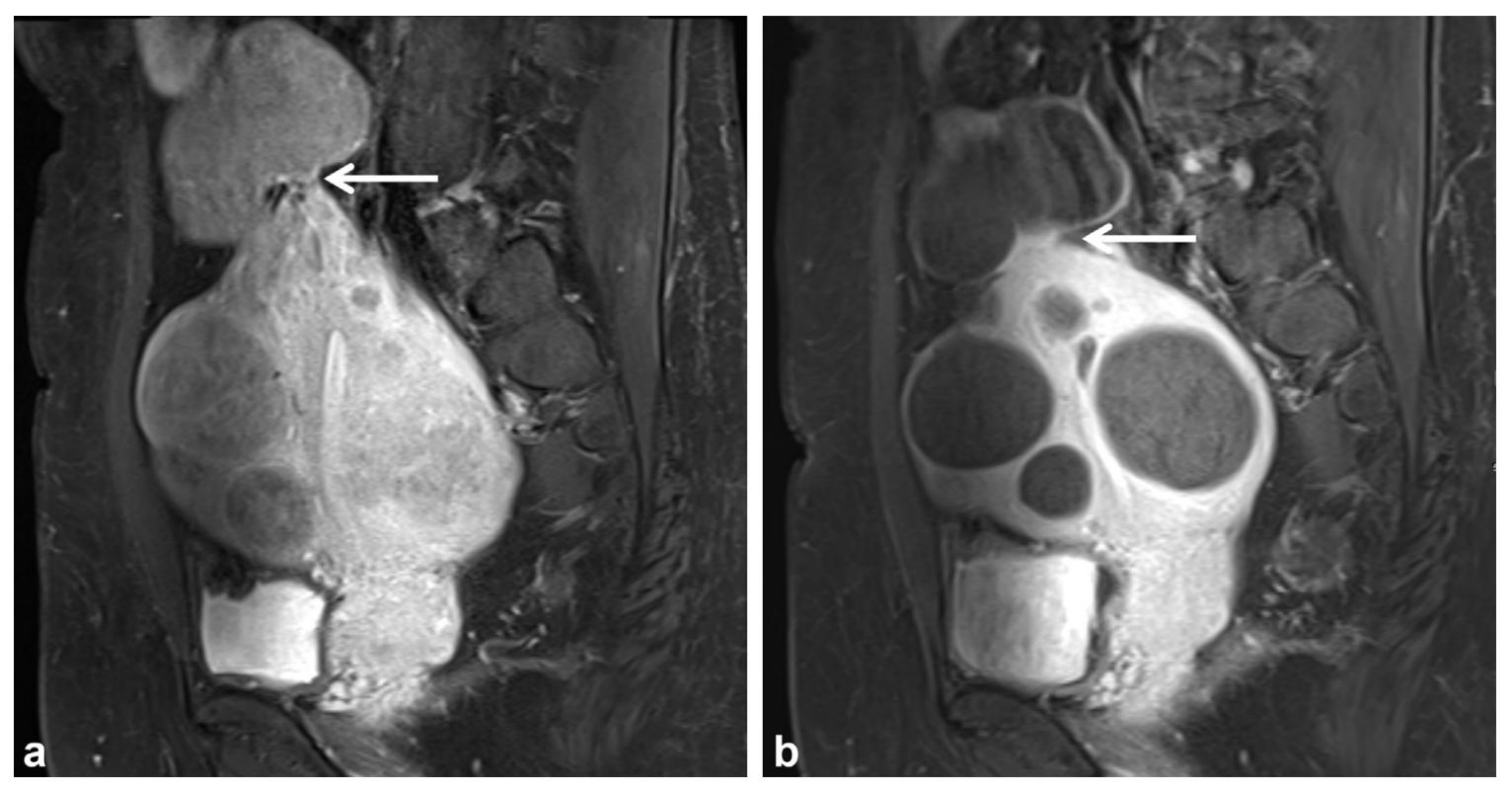 子宫肌瘤的位置、大小对介入栓塞疗效有何影响？