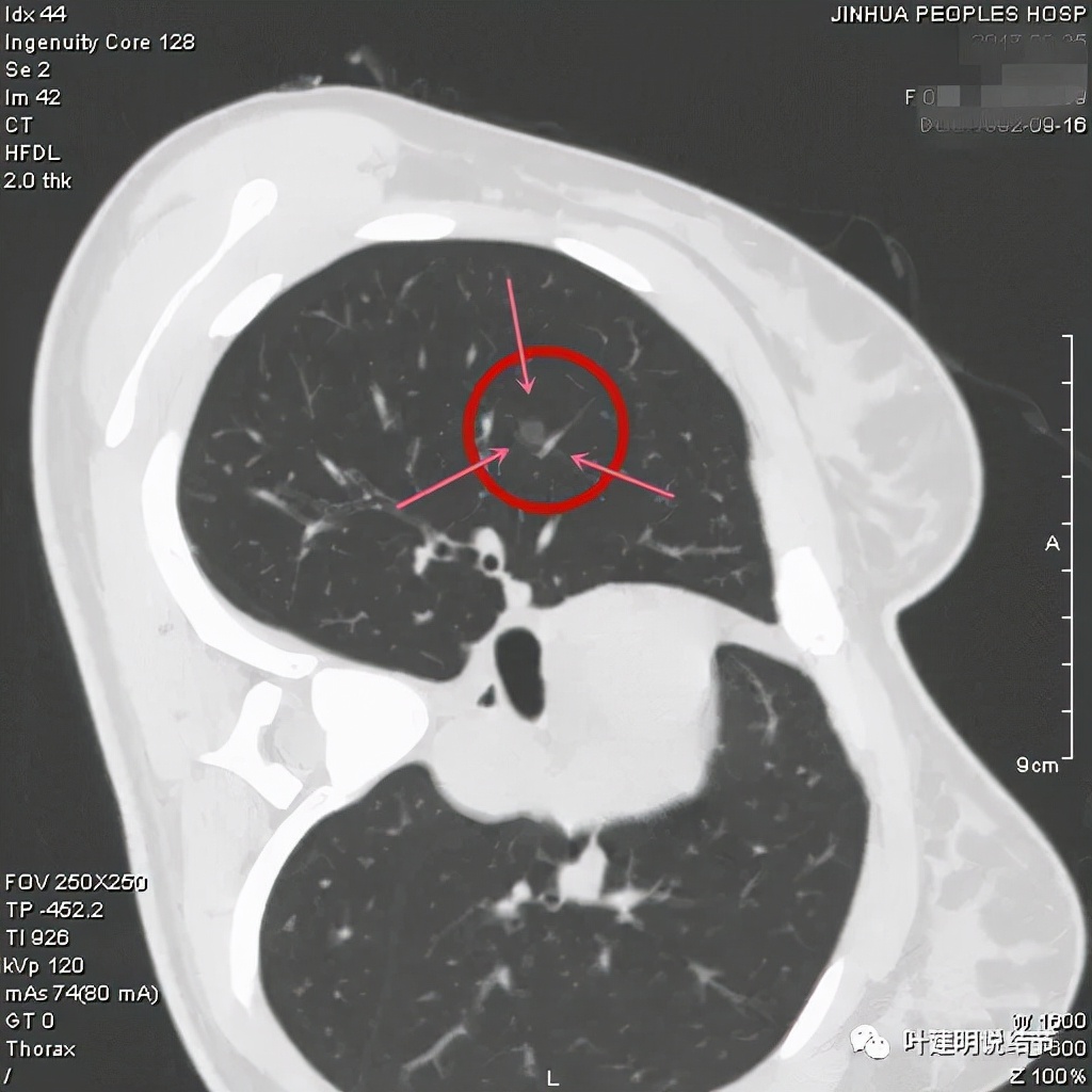 怎样从病理报告看是不是原位癌,原位腺癌切除子宫要开刀吗