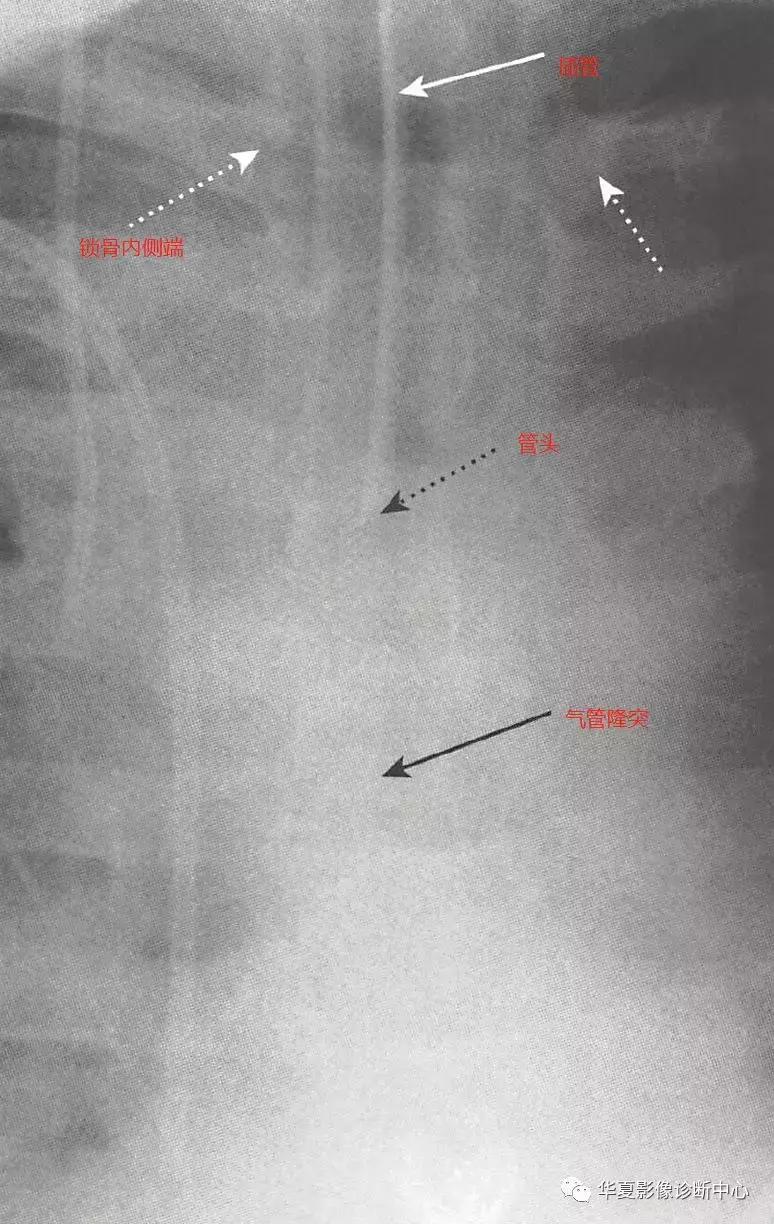 胸部x线影像与诊断基础,胸部置管