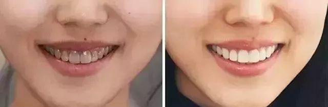 刷牙时一个小窍门彻底告别黄臭牙,刷牙的时候放点小苏打牙会变白吗