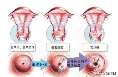 「科普时报」宫颈病变不能跟着感觉走