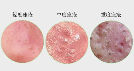 疮的形成原因和治疗方法,疮疡一般是由什么引起的