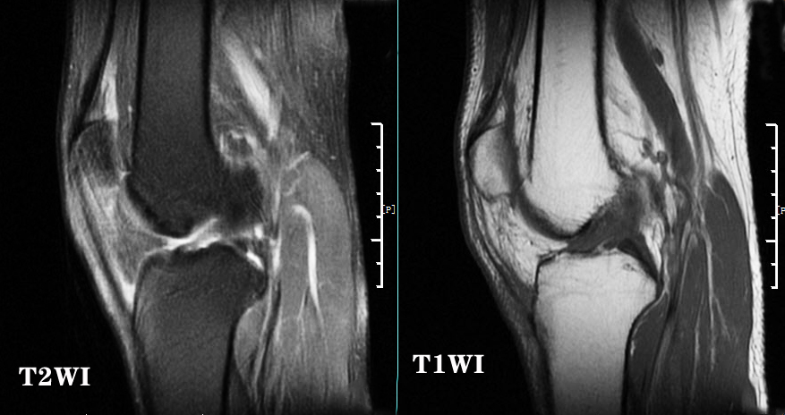 怎样能看懂膝关节核磁图片,如何看懂膝关节磁共振报告