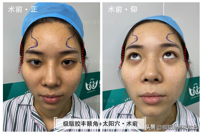 颧骨高只能颧骨内推？她怕开刀磨骨创伤大，仅做脂肪填充就改善了