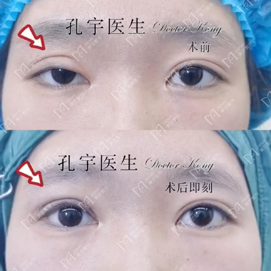 单眼上睑下垂修复术,上睑下垂眼睛修复手术成功率高吗