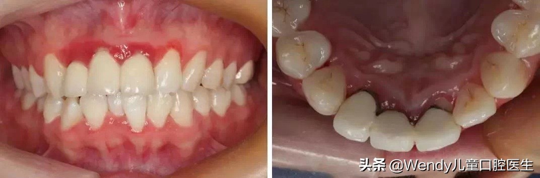 产后严重脱发吃什么钙,妈妈产后脱发严重如何自救