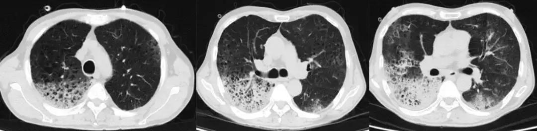 抗菌药物不合理处方分析,抗菌药物用药不合理的表现