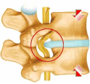 渭南治腰间盘突出哪家最好,脊柱神经外科手术