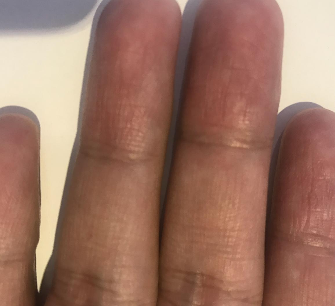 手指肚干瘪脱皮有褶皱原因,手指指腹干瘪起皱脱皮怎么办