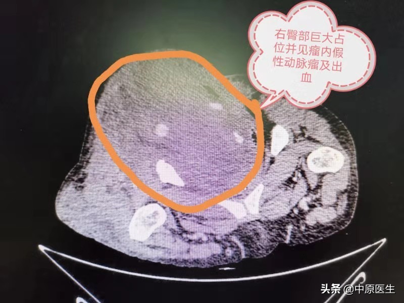 屁股上长个瘤怎么治疗,屁股上长了个瘤20多年了