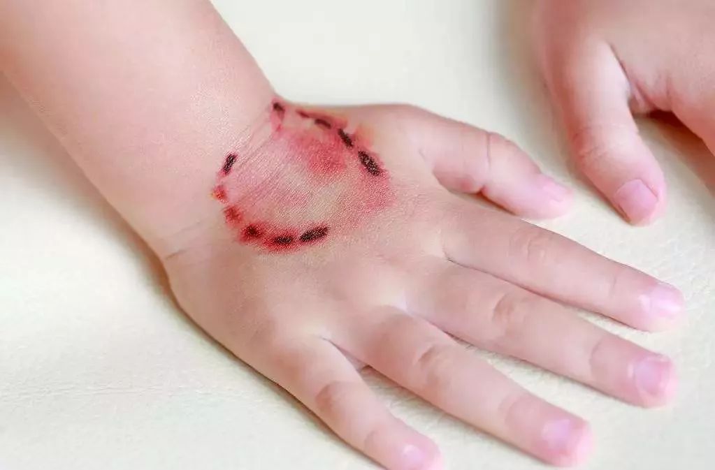 三岁女童手指被压断后续,小孩手指被夹伤需要多久才能恢复