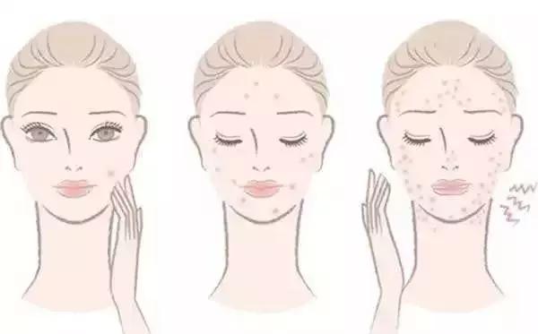 痘印反复冒痘怎么消除男生,痘印痘痘反反复复怎么办