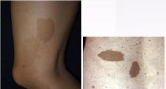 全身肿瘤怎么治疗,浑身长满肿瘤怎么办