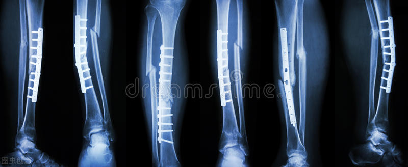 骨折钢板断裂医院怎么赔偿,钢板断二次骨折出院如何维权