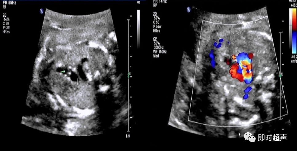 胎儿心脏三种血管关系模式图,25周的胎儿心脏弓切面多少正常