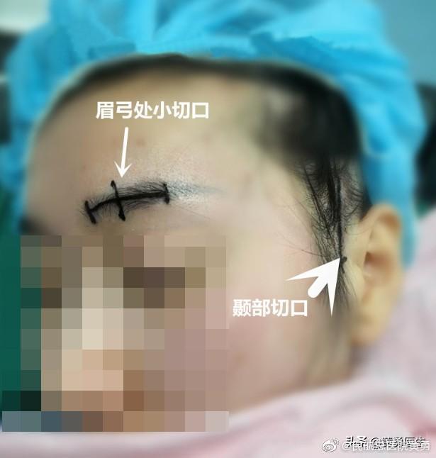 什么是偏头痛手术？患者手术的位置在什么地方？（图）一文了解