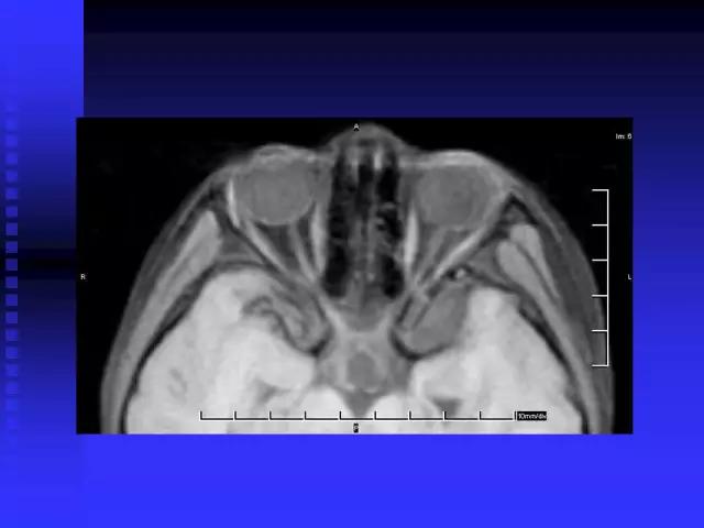 头颅mri读片视频教程,颅脑mri读片入门教程视频讲解全集