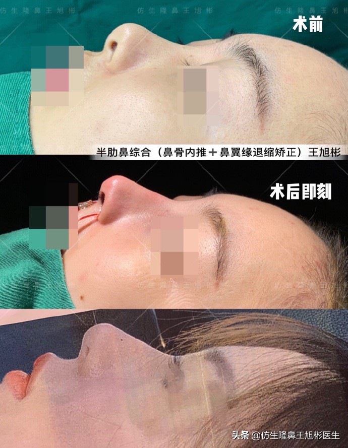 隆鼻的鼻翼怎么修复,隆鼻后多久可以做鼻翼缘矫正