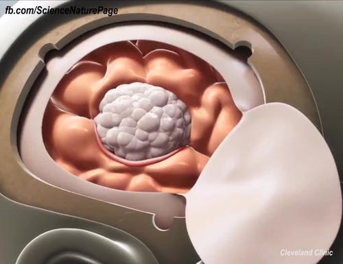 三甲医院医生揭露肿瘤治疗,脑部肿瘤怎么治疗最好