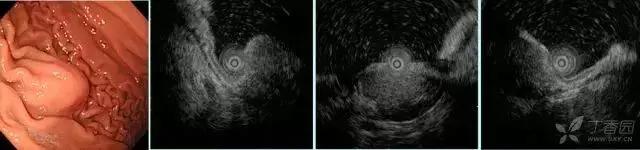 胃镜胃粘膜下隆起严重吗,胃镜提示粘膜下隆起病变