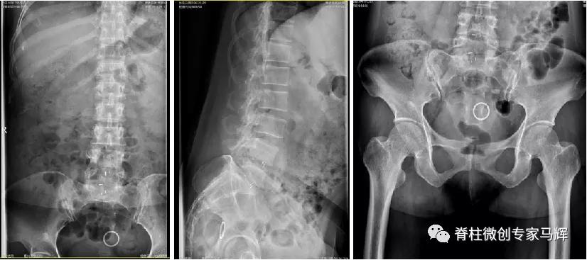 腰椎脓肿会发烧吗,腰间盘突出引起下肢疼痛发烧