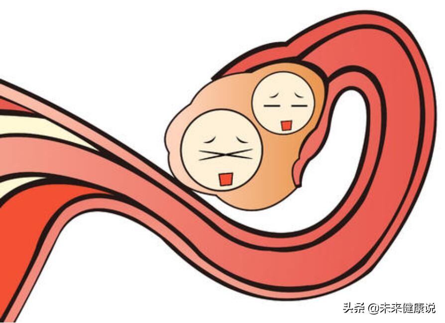 老婆肚子疼一检查黄体破裂,新婚小夫妻警惕黄体破裂