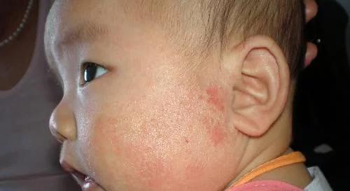 月嫂面试湿疹怎么处理,月嫂一走就长湿疹