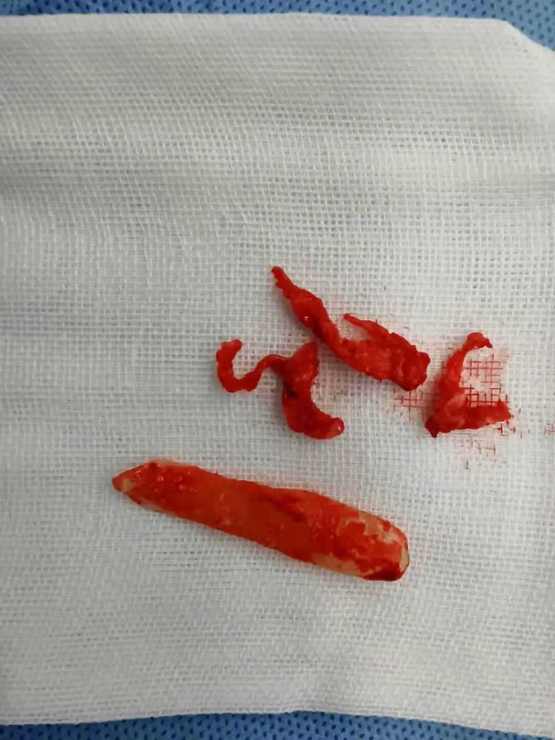 两例“古董级”硅胶假体成功取出