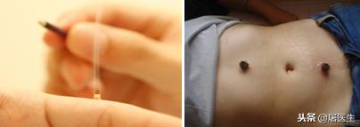 艾灸专家讲艾灸疗效,在家艾灸哪种灸法效果最好