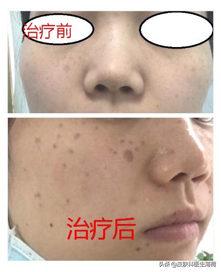 激光点阵祛痘坑收缩毛孔仪器,皮秒激光祛雀斑效果图